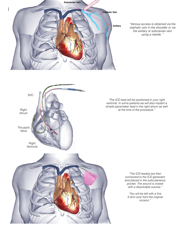 Doç.Dr.Osman Beton Implantable Cardioverter Defibrillator (ICD